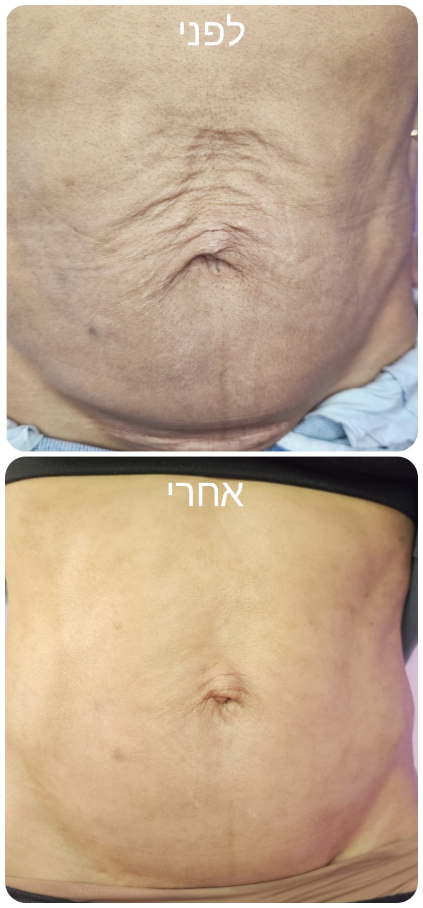 שיפור מרקם עור הבטן לפני ואחרי